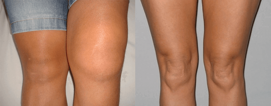 Εμπειρίες με τη χρήση καψουλών ελαίου κάνναβης πριν και μετά τη χρήση του Eva